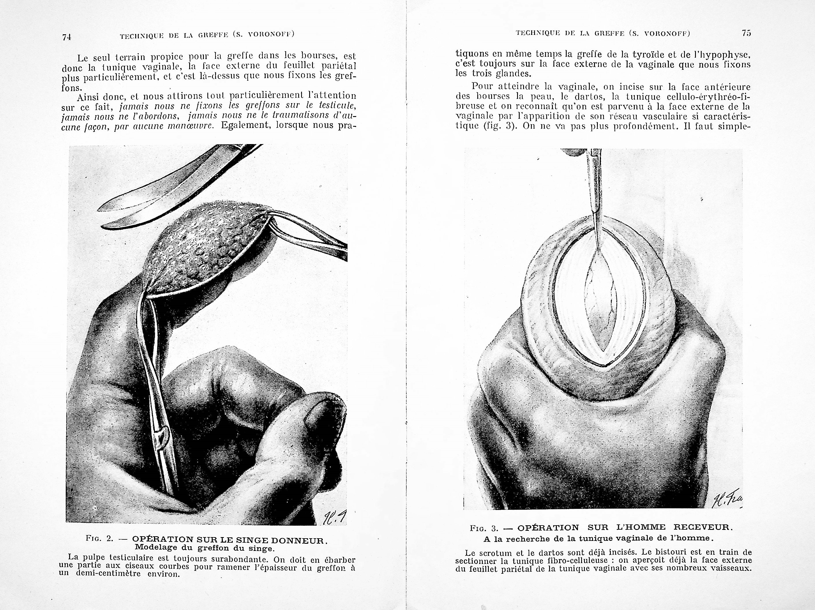 Image for 1) La greffe testiculaire. Technique operatoire, evolution histologique, manifestations physiologiques, published in Technique Chirurgicale, No 4, June 1967; 2) Testicular grafting from ape to man. Operative technique, histological evolution, physiological manifestations.