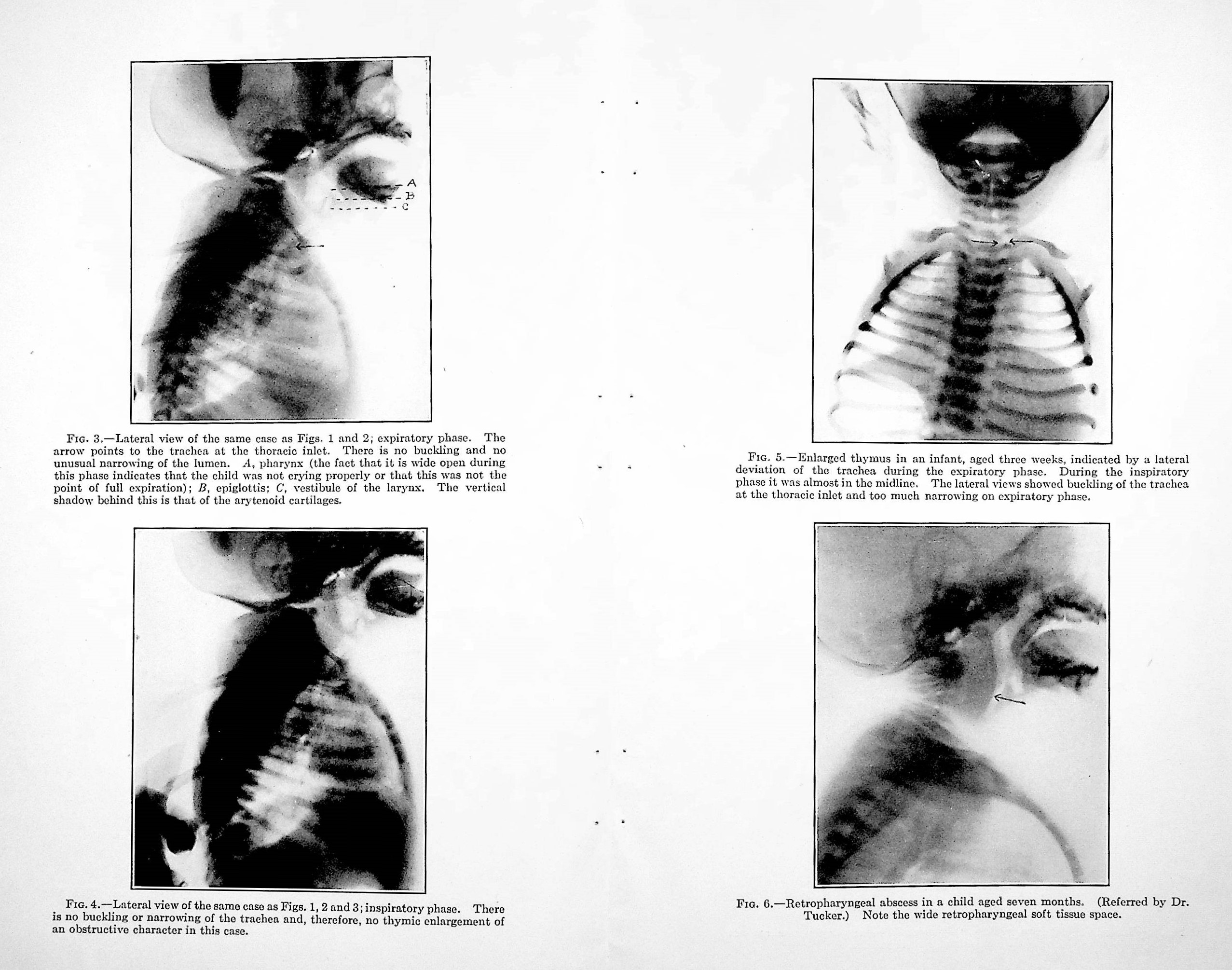 Image for Roentgenology of the thymus in infancy and differential diagnoses of enlarged thymus and its treatment