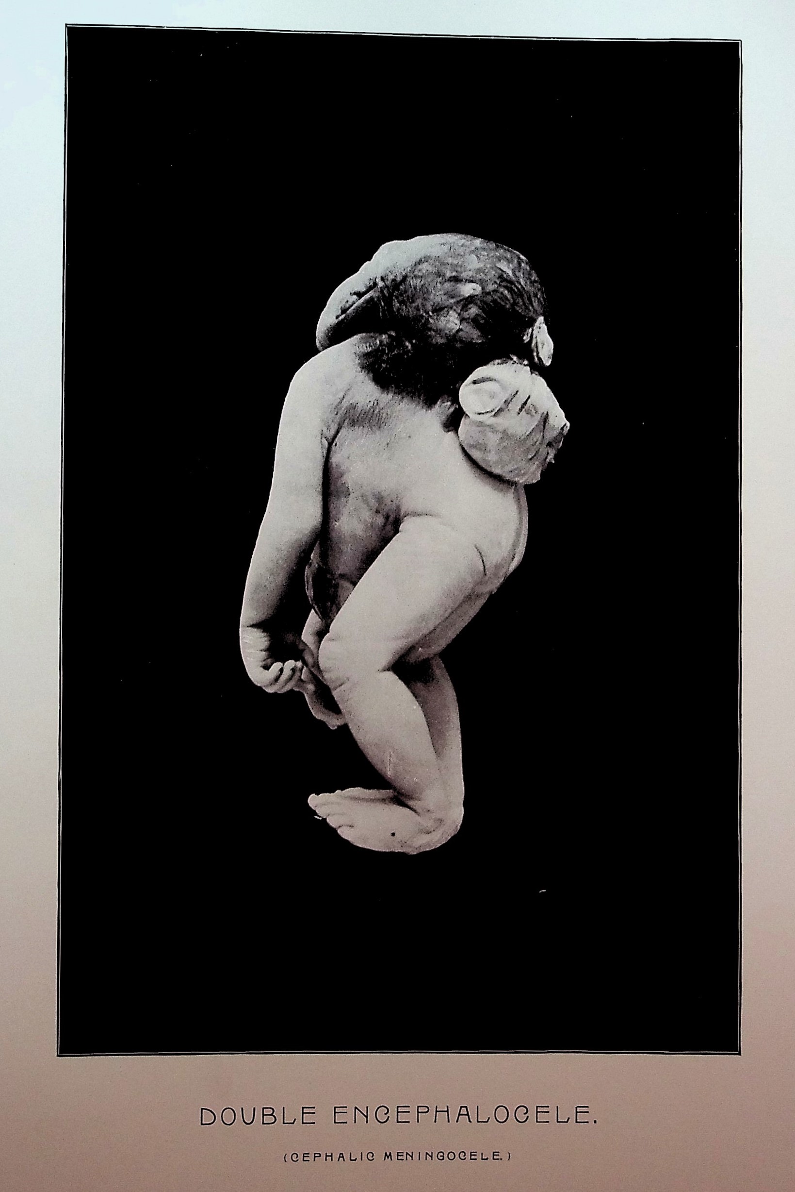 Human Monstrosities illustrated with Photographic Reproductions and Wood Engravings.