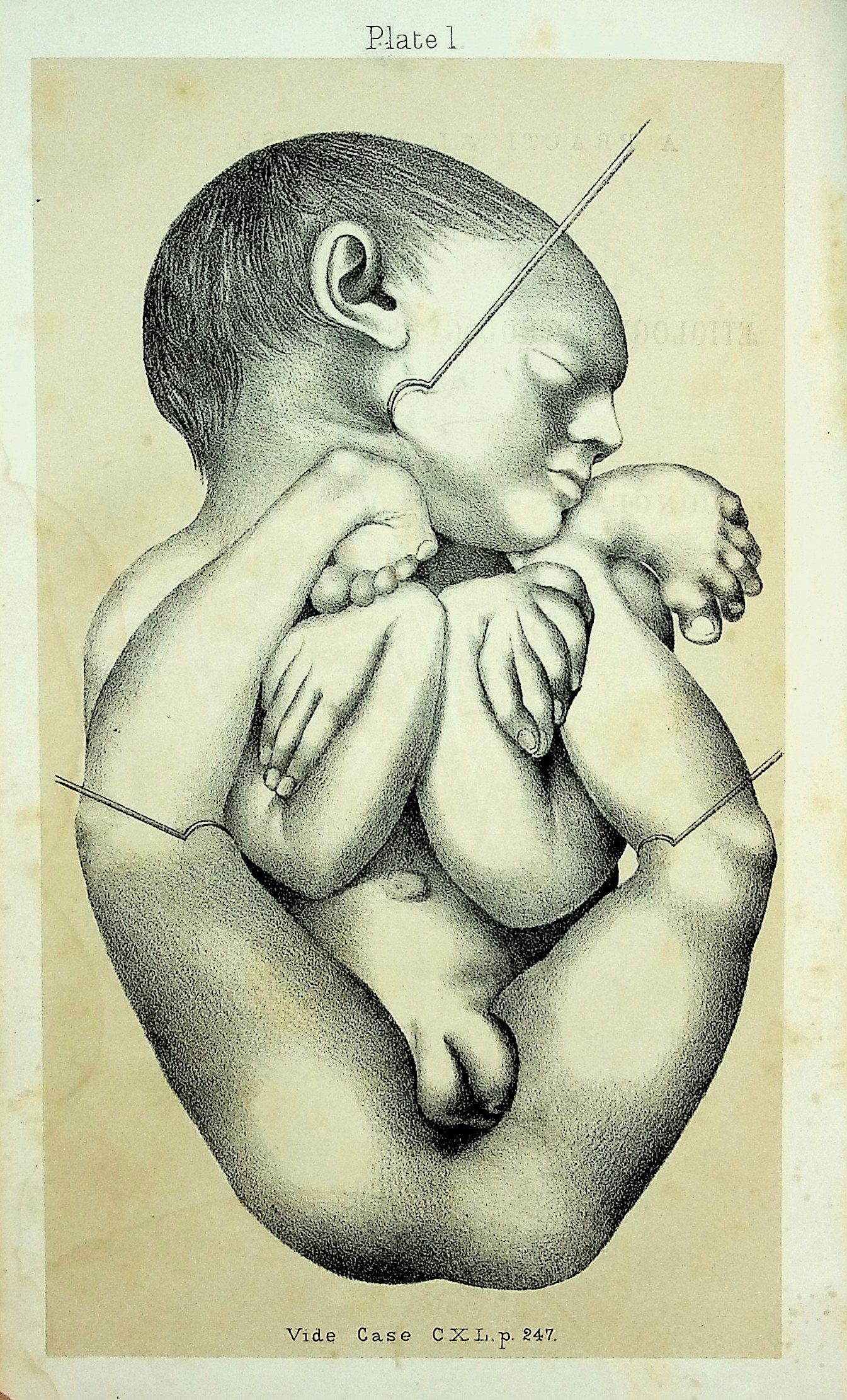 A Practical Treatise on the Aetiology, Pathology, and Treatment of the Congenital Malformations of the Rectum and Anus
