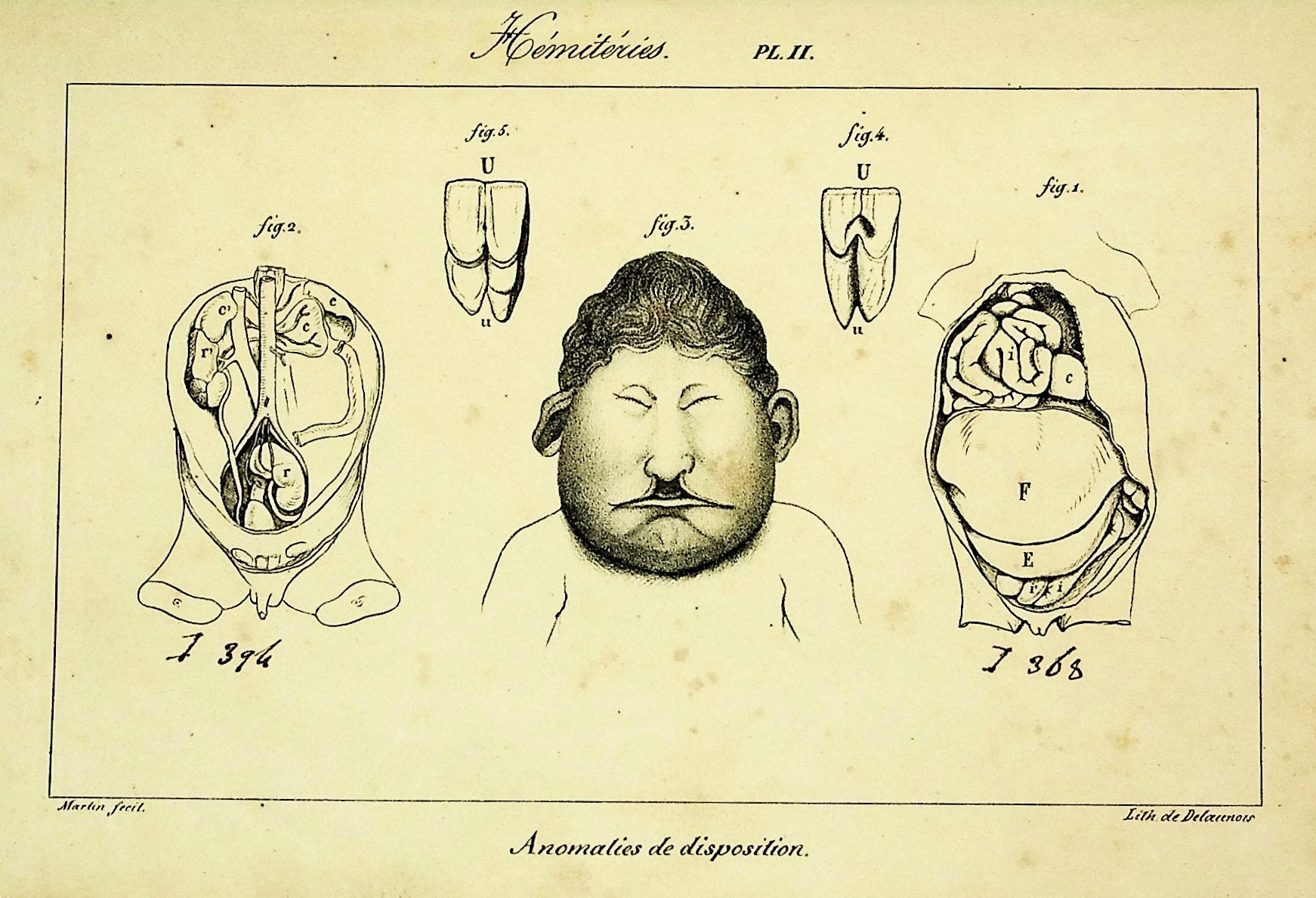 Histoire Generale et Particuliere des Anomalies de l'Organisation Chez l'Homme et les Animaux: Ouvrage Comrenant des Recherches Sur les Caracteres, la Classification, l'Influence Physiologique et Pathologique, les Rapports Generaux, les Lois et les Causes des Monstruosites, des Varietes et Vices de 