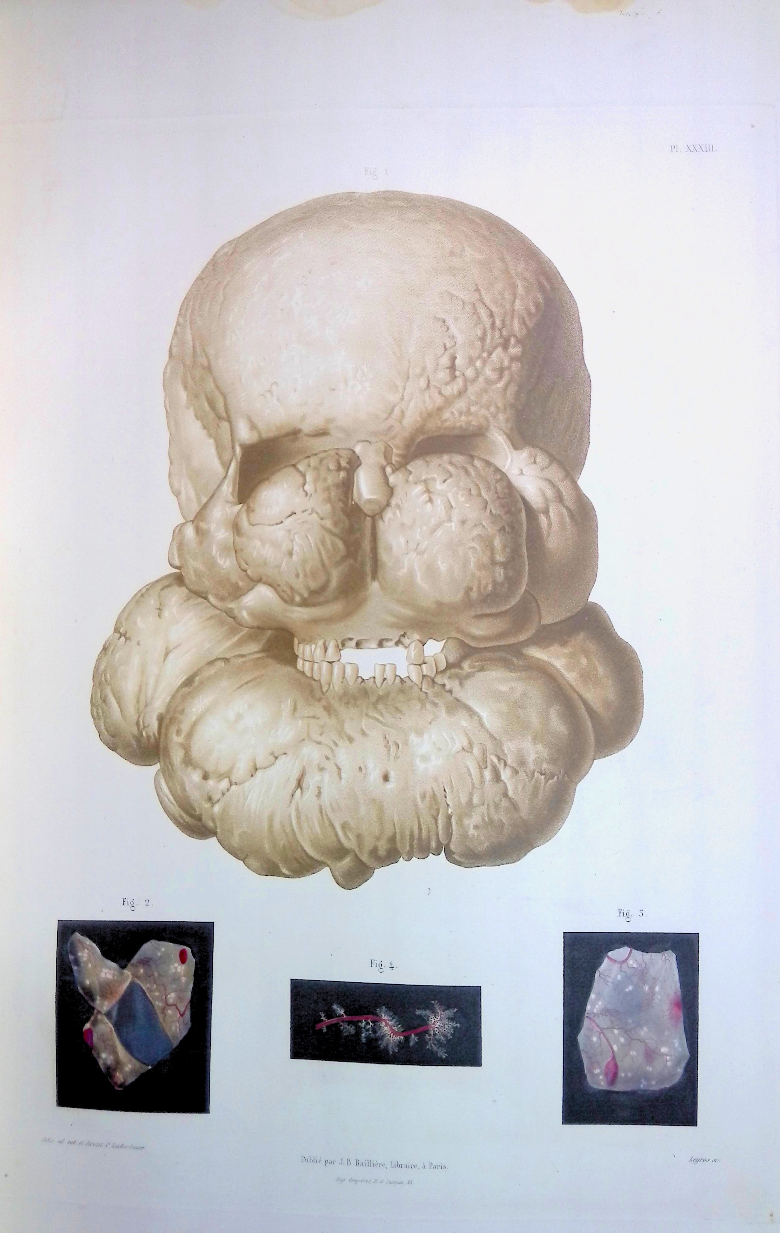 Traite d'Anatomie Pathologique Generale et Speciale ou Description et Iconographie Pathologique des Alterations Morbides Tant Liquides que Solides Observees dans le Corps Humain [Treatise on Pathologic Anatomy, General and Special, or Description and Pathologic Iconography of Morbid Alterations Both