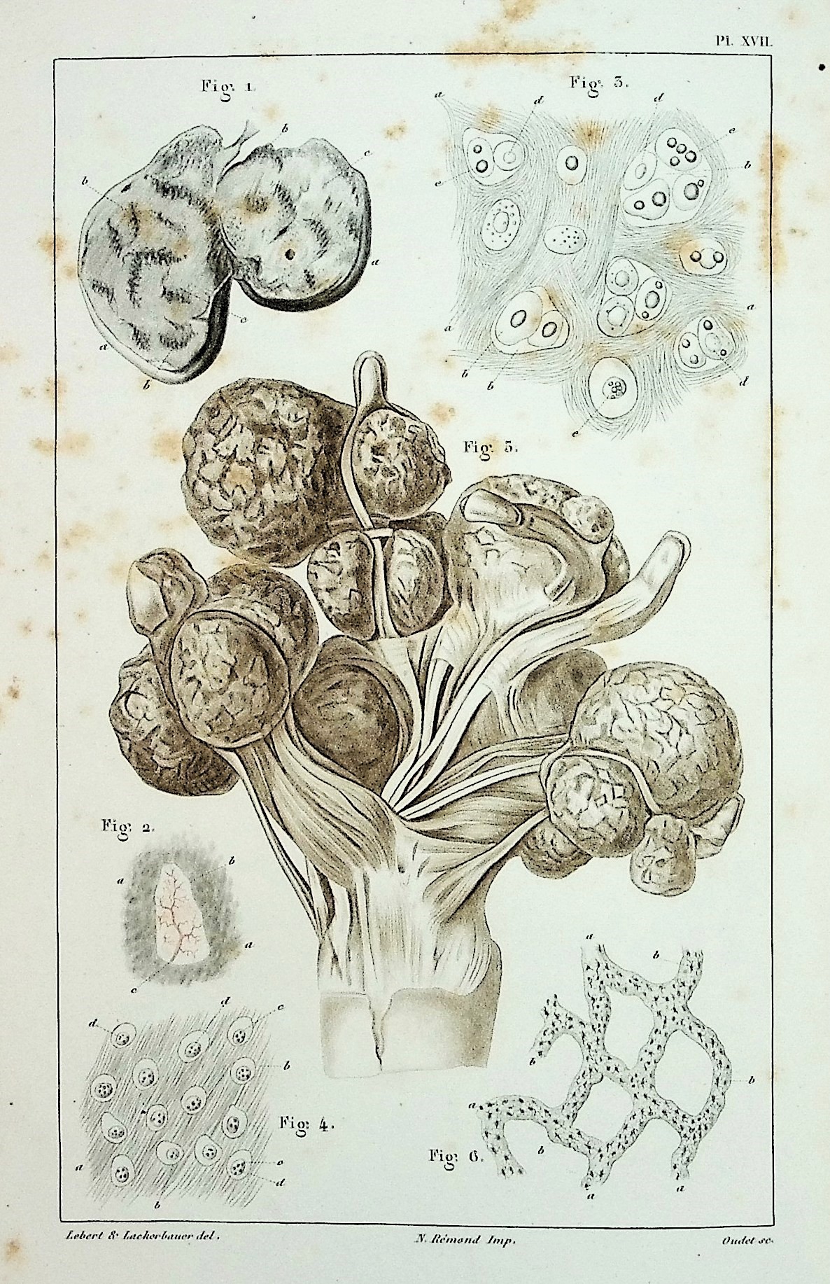 Physiologie Pathologique ou Recherces Cliniques, Experimentales et Microscopiques, sur l'Inflammation, la Tuberculasation, les Tumerus, la Formation du Cal, Etc. [Pathologic Physiology or Clinical Research, Experimental and Microscopic, on Inflammation, Tuberculosis, Tumors, Formation of Calcificati