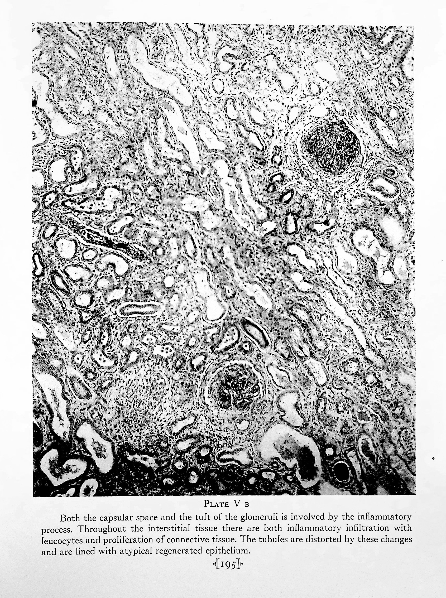 The Renal Lesion in Bright's Disease