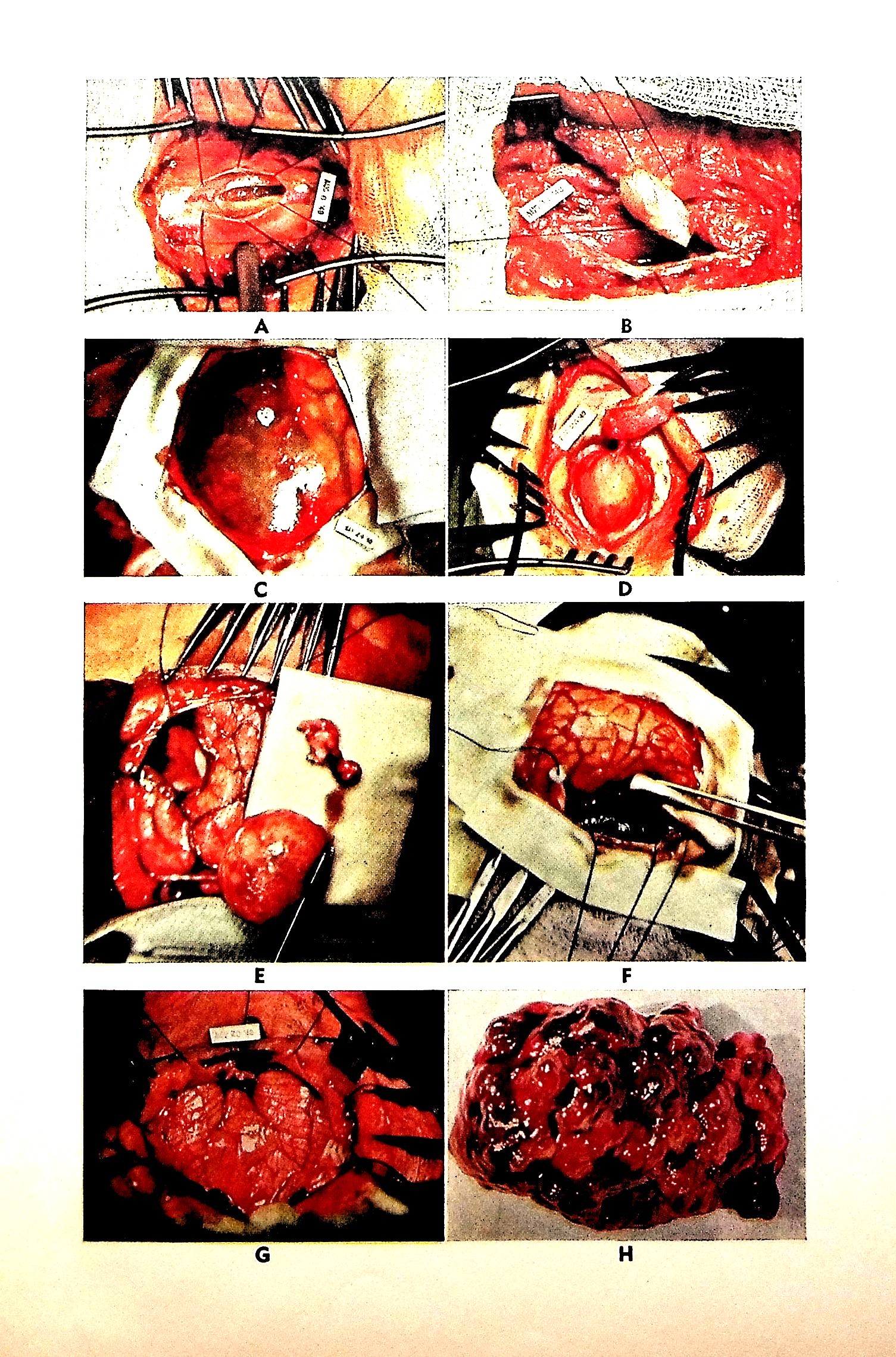 Neurosurgery of Infancy and Childhood