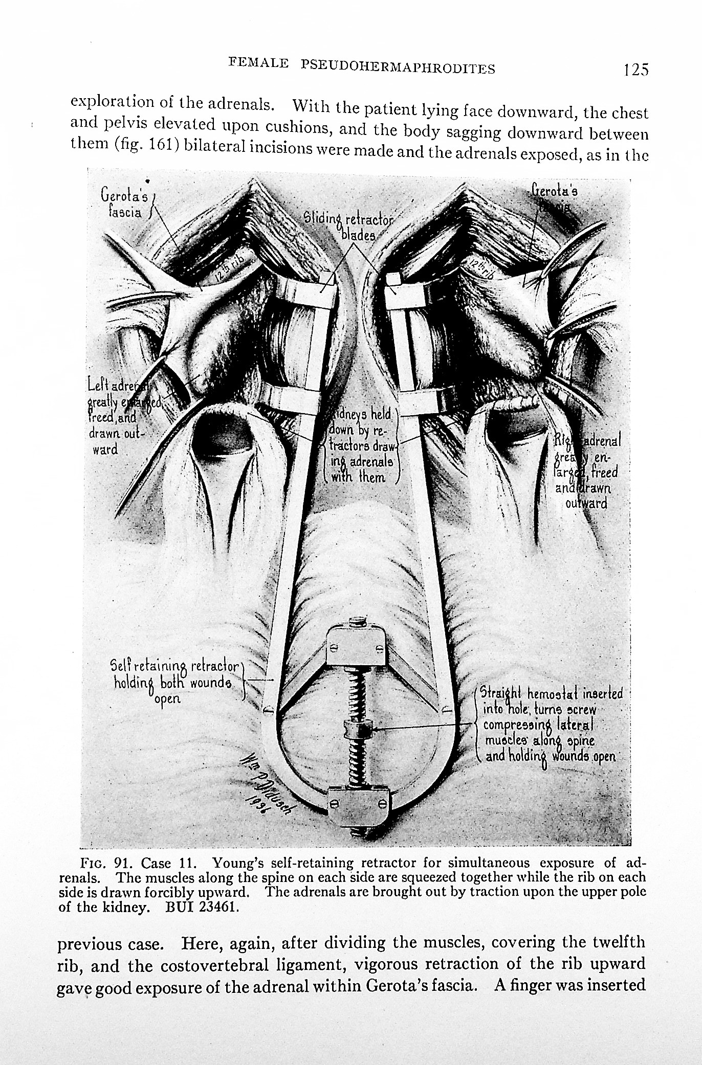Genital Abnormalities, Hermaphroditism & Related Adrenal Diseases