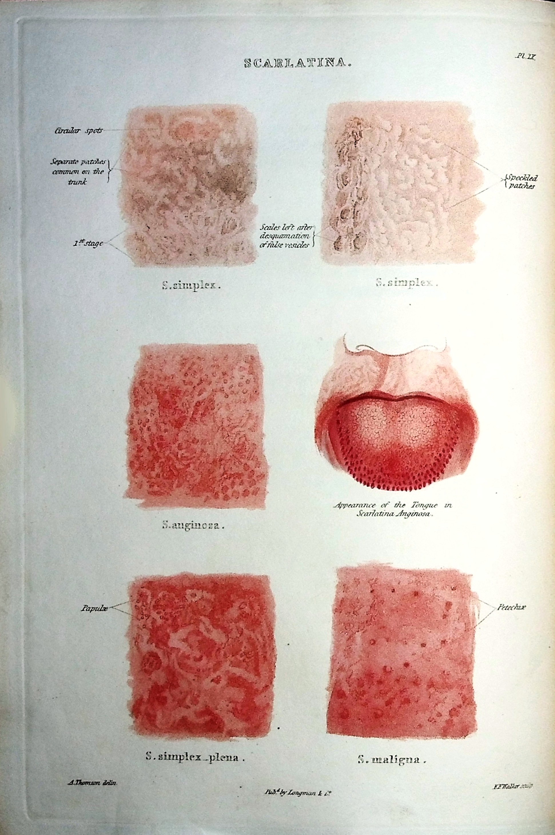 Atlas of Delineations of Cutaneous Eruptions Illustrative of the Descriptions in the Practical Synopsis of Cutaneous Diseases of Thomas Bateman