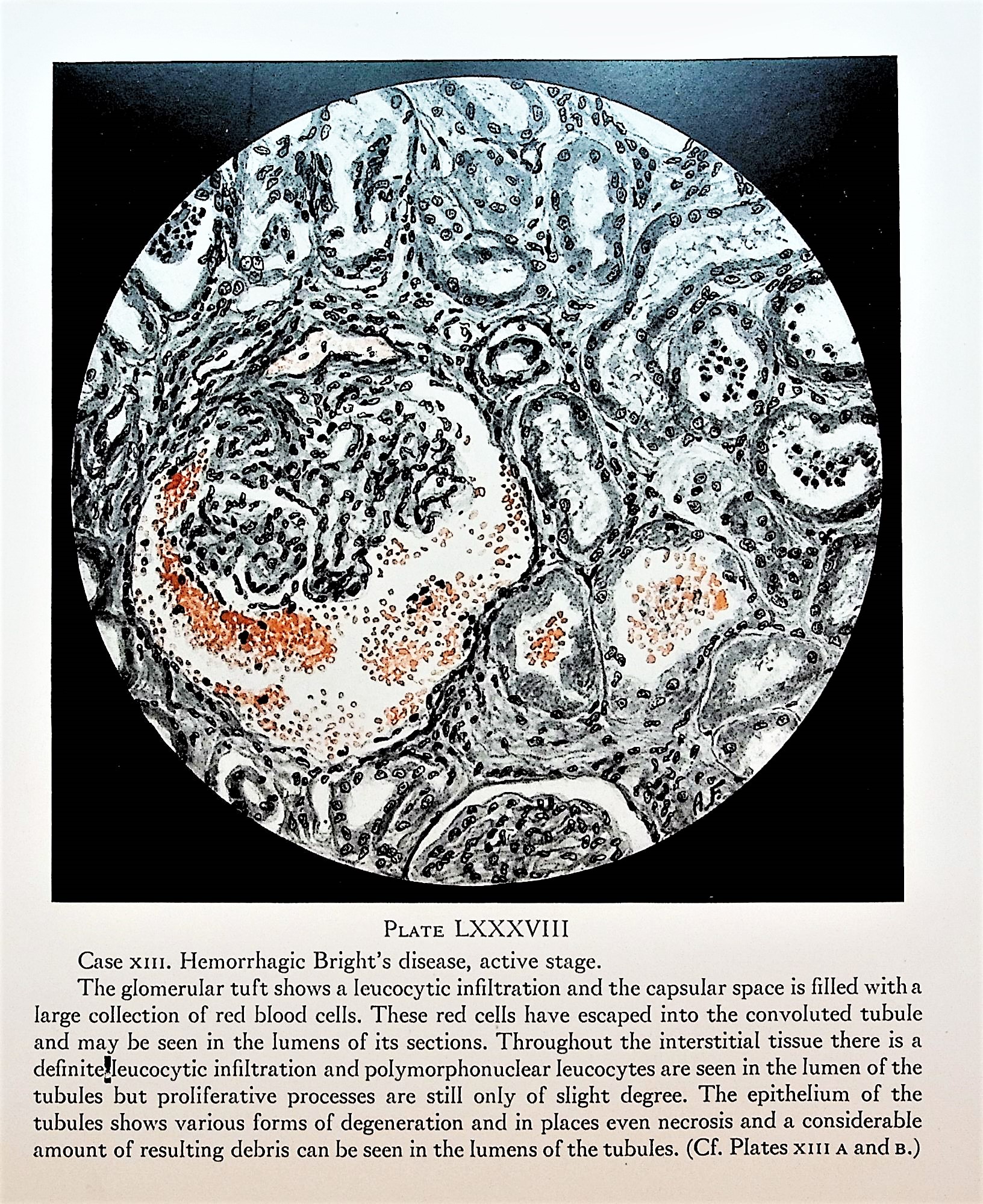 The Renal Lesion in Bright's Disease