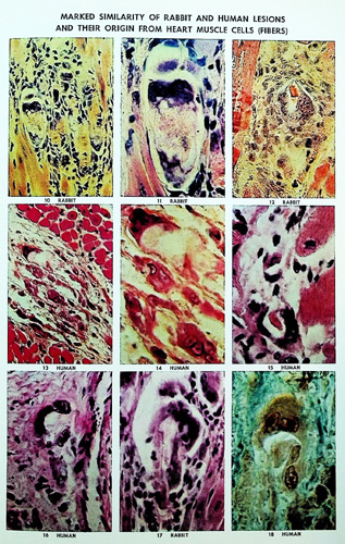 Image for Nature of Rheumatic Heart Disease, with Special Reference to Myocardial Disease and Heart Failure, with 162 Photomicrographic Illustrations in Color
